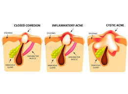 Las protuberancias son causadas por el acné. Types Of Acne Closed Comedones Inflammatory Acne Cystic Acne The Structure Of The Skin Infographics Stock Vector Illustration Of Healthy Bacteria 127784718