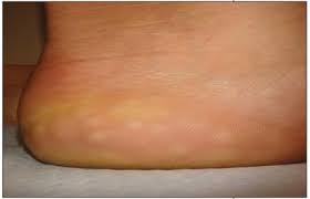 Lumps are common with many ent disorders. Piezogenic Pedal Papules Consultant360