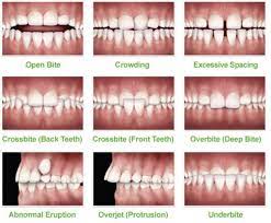 Don't think your child needs crossbite correction? Kids Orthodontics Firstbite Dental Essendon Dentist