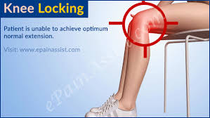 A meniscus tear is the most common cause of a true knee lock. How To Unlock The Knee