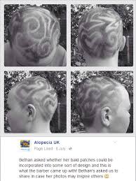 Over time, however, hair follicles can become irreversibly damaged so that the. Alopecia Areata Bald Patches Incorporated Into Haircut