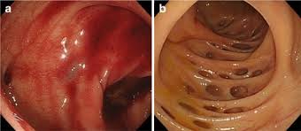 Image result for Diverticular Bleeding