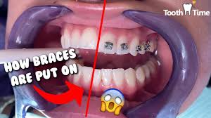 How to get braces for free in south africa. Braces For Kids Costs And Does Your Child Need Them