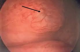Endometriosis is a condition described as growth of ectopically located endometrial tissue in sites other than uterine cavity. A Multidisciplinary Approach To The Patient With Deep Infiltrating Endometriosis