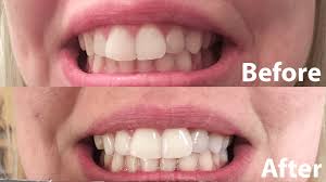 Best Teeth Whitening Products For Your Wedding Smile Ottawa Wedding Journal