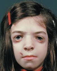 Nach unten geneigte lidspalten, kolobom des unteren lides, teilweise fehlende untere zilien. Franceschetti Syndrom Treacher Collins Syndrom Der Icd10 Ist Eine Internationale Klassifikation Von Diagnosen Okesehonihe