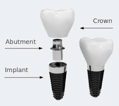 Diantaranya ada 3 jenis gigi palsu permanen, yaitu crown, bridge dan juga implant gigi. Jenis Dan Bahan Gigi Palsu Audy Dental