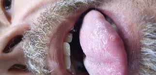 Eine aphthe ˈaftə (transliteration von altgriechisch ἄφθη, vom verb ἅπτω haptō, deutsch ‚entfachen') ist eine schmerzhafte, von einem entzündlichen randsaum umgebene schädigung der schleimhaut des zahnfleischs, der mundhöhle einschließlich der lippen, der tonsillen oder der zunge. Aphten Auf Zunge