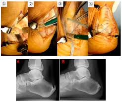 Applied Sciences Free Full Text Effects Of Achilles Tendon Moment Arm Length On Insertional Achilles Tendinopathy Html