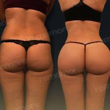 رفع المؤخرة البرازيلية صور قبل وبعد | Bookimed