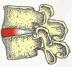 Image result for vyhřezlá ploténka