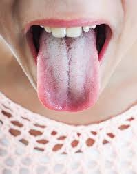 Image result for Oral thrush roof of mouth