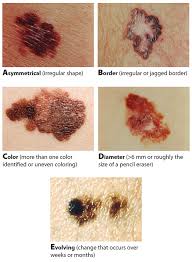 What patients and caregivers need to know about. Melanoma Mitigation The Key To Higher Survival Rates