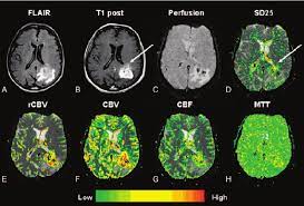 A H Glioblastoma Multiforme Grade Iv Iv Top Row Left To Right Download Scientific Diagram