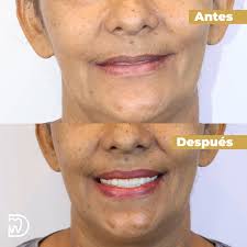 🦷 ¡Recupera tu sonrisa completa! 😁 ¿Sabías que una prótesis completa es  la solución perfecta para quienes han perdido todos sus dientes naturales?  💯 Con una apariencia natural y comodidad garantizada, te