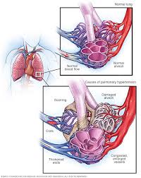 On this page pain can be a symptom of lung cancer, but can also be a side effect of treatment. Pulmonary Hypertension Symptoms And Causes Mayo Clinic