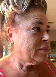 🩷January 3, Surgery date. No anesthesia….Took a couple of Ambien, I think  it was. And then they injected my face to numb it.. I had face lift, chin  lift, and CO2 laser.