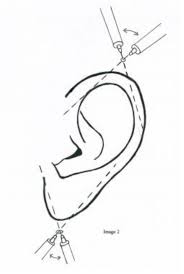 Image result for Ear Nerve Block
