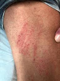 Rashes On Inner Thigh Lead To A Lot Of Itching Irritation And Frustration They Can Be Caused Due T Home Remedies For Rashes Rashes Remedies Inner Thigh Rash