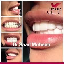 ابتسامة تلو الاخرى نرسمها بمهارة وإتقان وبأفضل معايير الجودة تم تركيب عدسات اللومينير لدى د سعد محسن للحجز المونسيه 0544229 clinic doctor pearls