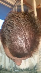 Treatment generally involves shaving off affected areas. Diffuse Hair Loss Or Male Pattern Baldness Hairlosstalk Forums