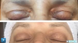 Xanthelasma removal in london & harley street. Client Before And After Images Xanthel