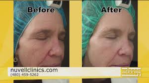 Look Years Younger in Minutes at Nuvell Clinics