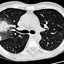The illnesses resulting from aspergillosis infection usually affect the respiratory system, but their signs and severity vary greatly. Invasive Pulmonary Aspergillus Infection High Resolution Ct Scan Of Download Scientific Diagram
