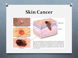 Although not common, it is possible to bleed through your skin or bleed through the skin pores, even where there is no cut. Skin Cancer Ppt Video Online Download