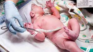 The Truth About Nuchal Cords Umbilical Cord Around Baby S Neck