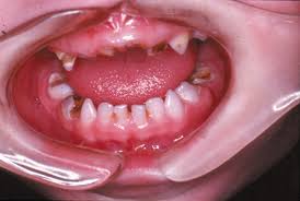 Dental Disease In Children With Chronic Illness Archives Of Disease In Childhood