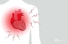 Myocarditis is an inflammation of the heart muscle. Case Study Suggests That Gout Crystals Can Settle In The Heart