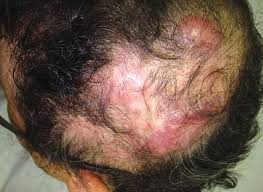 Hair loss isn't what i expected it to be. Scielo Brasil Primary Cutaneous Centrofollicular Lymphoma With A Good Response To Radiotherapy Primary Cutaneous Centrofollicular Lymphoma With A Good Response To Radiotherapy