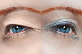 If your eyelids touch the top of your pupil, you have hooded eyes. Eyelid Surgery Options For Improving Appearance All About Vision