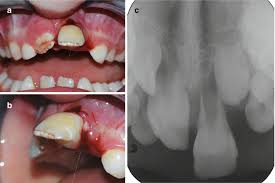 Image result for Tooth Luxation