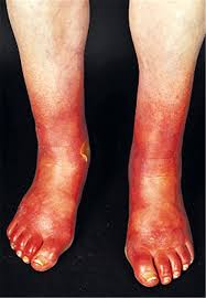 Rote Socken Durch Kranke Gefasse