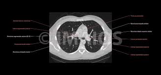 Ct scan of the chest (thorax). Anatomie Des Thorax Ct