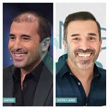 Fernando rocha mostra antes e depois ao lado de sua foto de tamanho real. Um Ano Apos Transplante Capilar Veja O Antes E Depois De Marco Horacio Atualidade Sapo Lifestyle