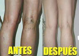 Crema Para Eliminar Las Varices Tratamiento 100 Natural Curar Venas Varicosas Ebay