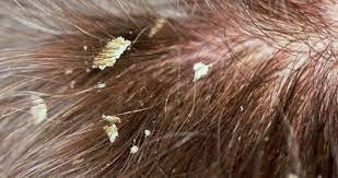 Mungkin hampir semua orang pernah mengalami flu dan batuk. Tips Dan Cara Menghilangkan Kelemumur Berkuping Hilangkan Kelemumur