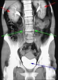 Skriv misstanken så att det inte missas! Ureter Normal Ct Laegehandbogen Pa Sundhed Dk
