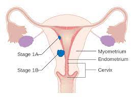 The uterus has the body and the neck. File Diagram Showing Stage 1a And 1b Cancer Of The Womb Cruk 196 Svg Wikimedia Commons