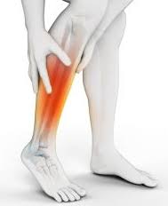Image result for shin splints
