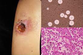 Mucormicosis cutánea en un paciente inmunocomprometido, revista chilena de infectología. Afectacion Cutanea En Las Micosis Profundas Una Revision De La Literatura Parte 2 Micosis Sistemicas Sciencedirect