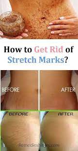 How To Get Rid Of Stretch Marks Naturally Stretch Mark Remedies Stretch Marks Stretch Marks Cure