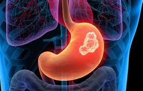 Le cancer de l'estomac est une forme de cancer se développant aux dépens de la paroi gastrique. Cancer De L Estomac A Lyon Centre De Chirurgie Digestive Et Viscerale