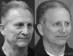 Cosmetic Surgery for Men by BCK Patel in Salt Lake City St George Utah