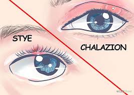 How To Get Rid Of A Stye In 2020 Eye Stye Remedies Stye Remedy Stye Treatment