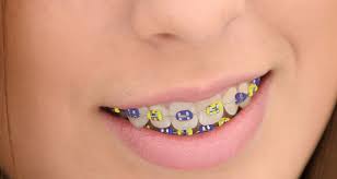 See full list on wikihow.com The Secret To Sleeping Comfortably With Braces