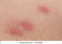Image result for flea bite